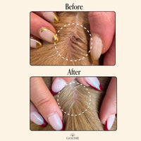 Two images show hands parting hair to reveal a scalp. The "Before" image shows dryness and irritation, while the "After" image appears healthier and smoother after using Goldie - Miracle Mist by Goldie.